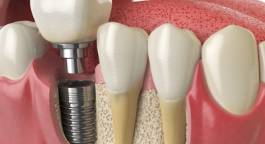 Diş Tedavisinde Yeni Dönem: İmplant SSK Kapsamına Giriyor