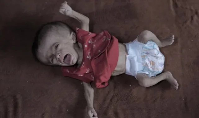 Gazze’de 5 Aylık Remzi Bahara Açlıkla Yaşam Mücadelesi Veriyor