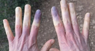 Ciltte Maviye Dönük Soluk Renge Dikkat