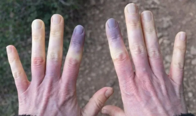  Ciltte Maviye Dönük Soluk Renge Dikkat