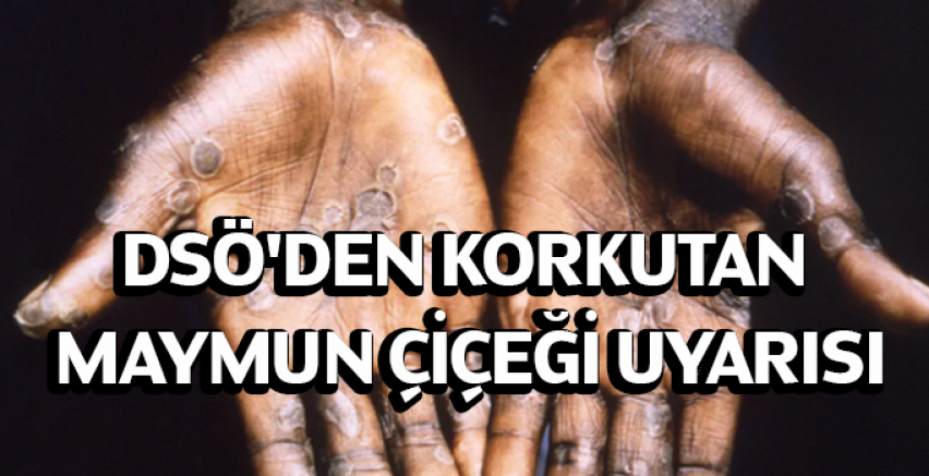 DSÖ'den korkutan maymun çiçeği uyarısı