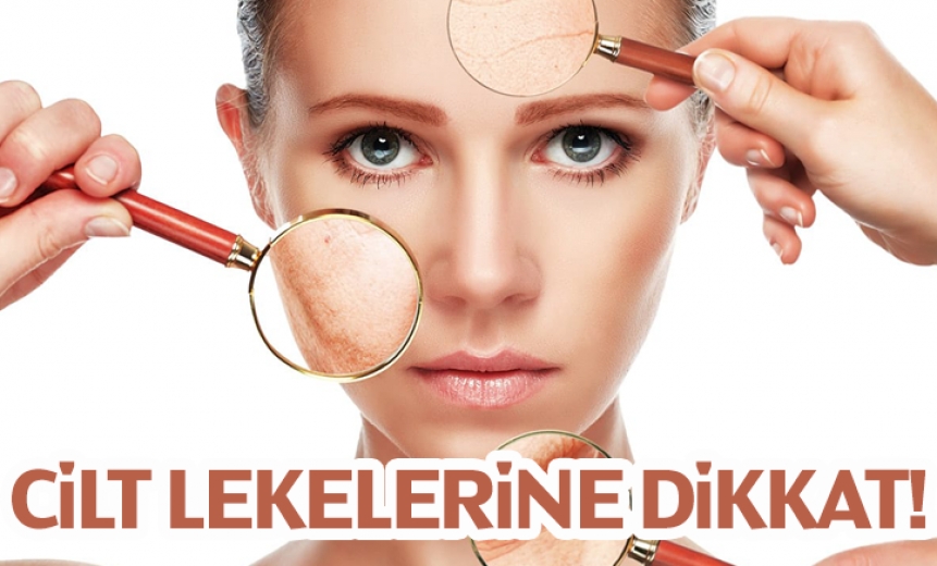 Güneşle Gelen Cilt Lekelerine Dikkat!