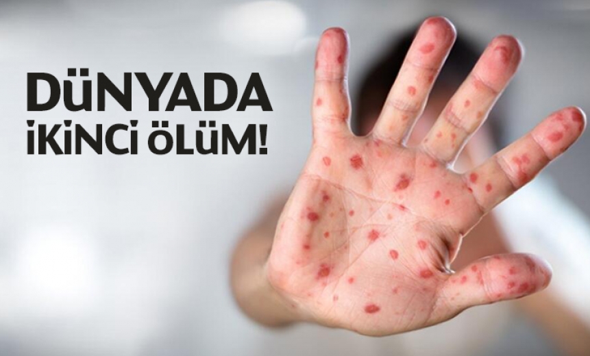 Maymun Çiçeği Virüsünde İkinci Ölüm