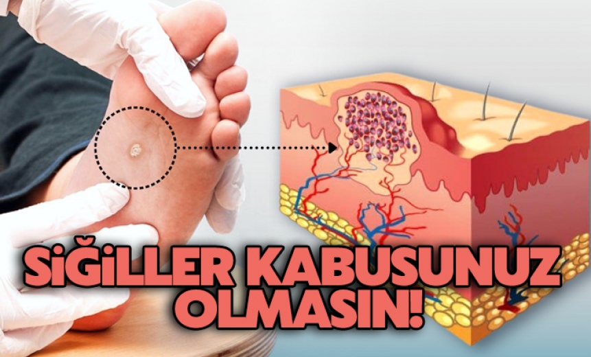 Siğiller Kâbusunuz Olmasın