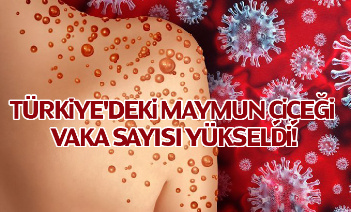 Türkiye'deki maymun çiçeği vaka sayısı 11'e yükseldi